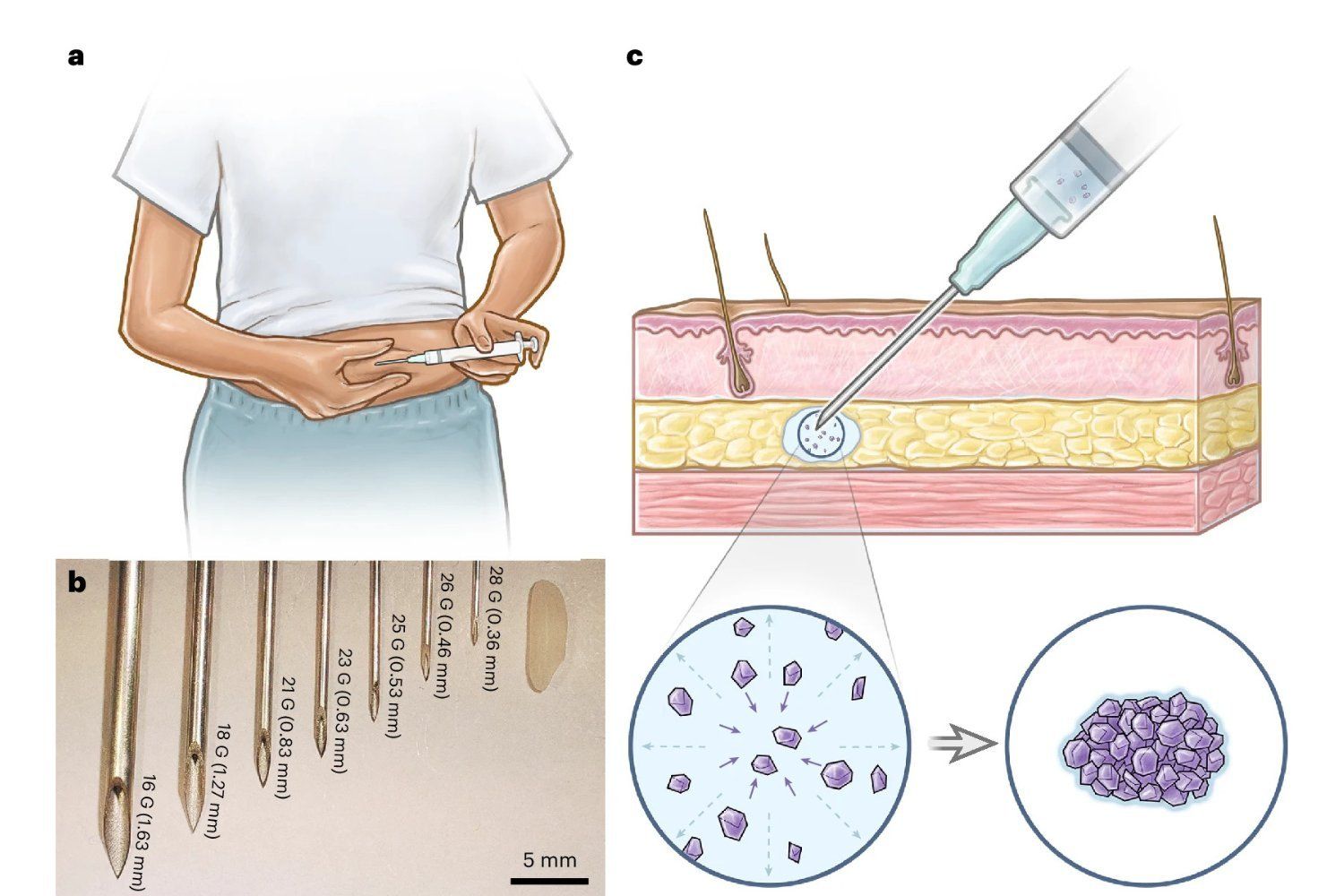 Implant Contraceptif