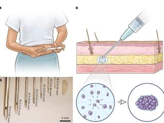 thumbnail - Implant Contraceptif
