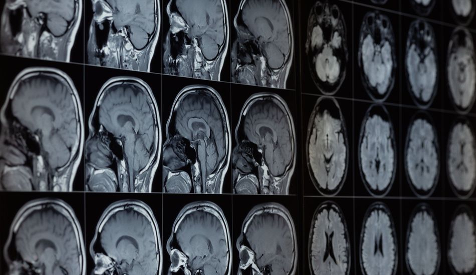 Maladie d'Alzheimer